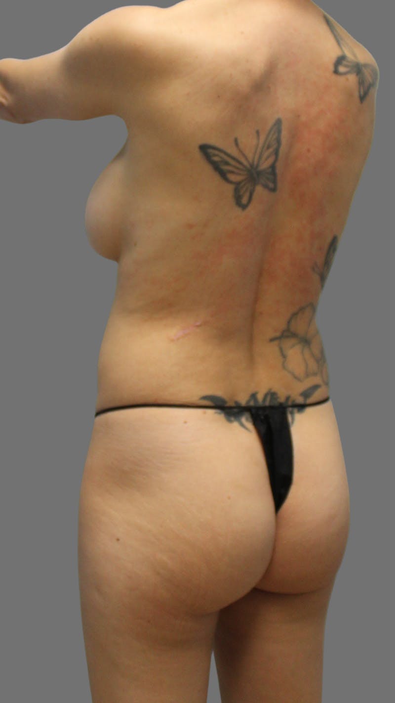 Brazilian Butt Lift Before & After Gallery - Patient 257609 - Image 3