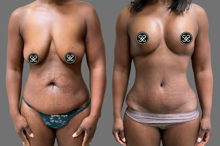 Mommy Makeover with Breast Lift by Dr. Summers