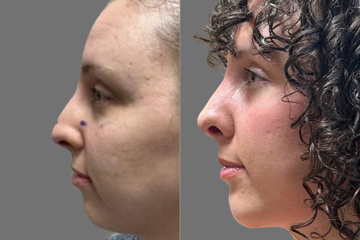 Rhinoplasty and Chin Augmentation by Dr. Iannitti