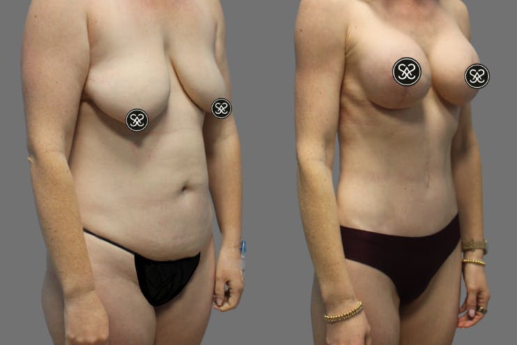 Mommy Makeover performed by Dr. Deal