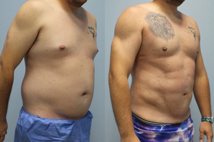 Hi Def liposuction performed by Dr. Deal