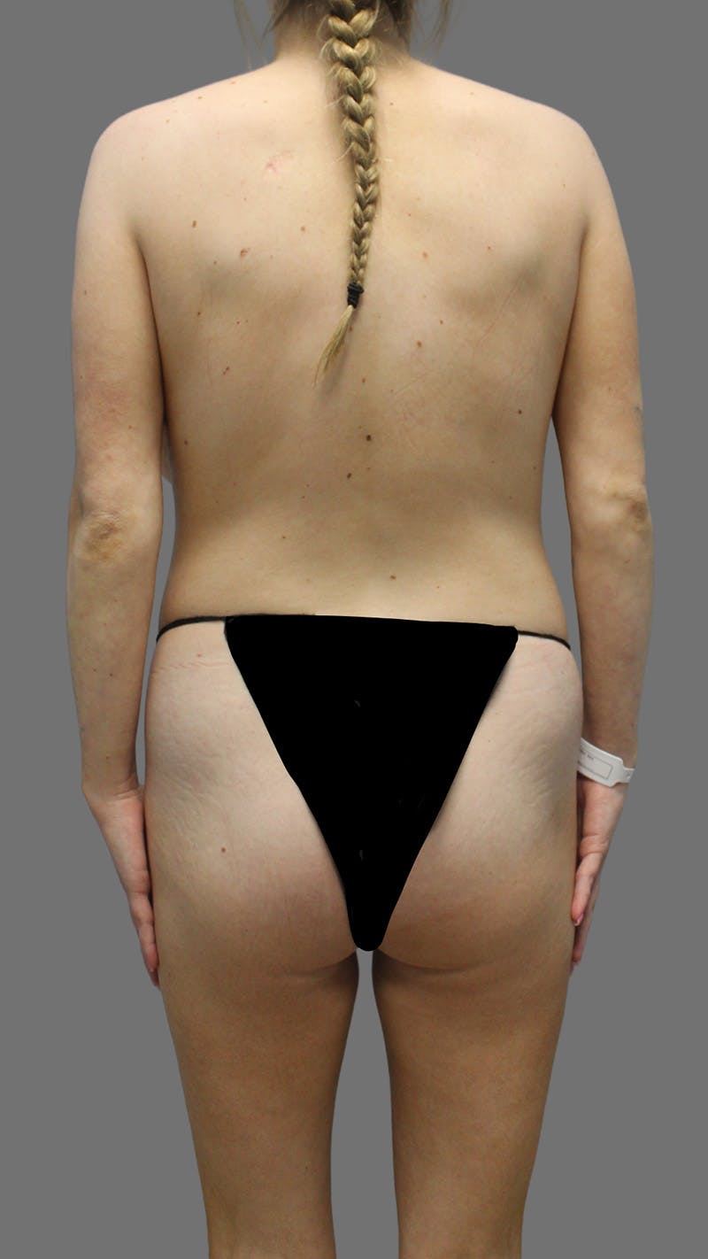 Brazilian Butt Lift Before & After Gallery - Patient 208773 - Image 1