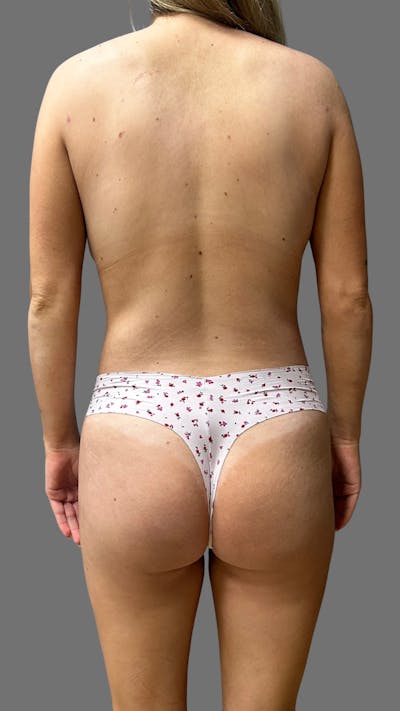 Brazilian Butt Lift Before & After Gallery - Patient 208773 - Image 2