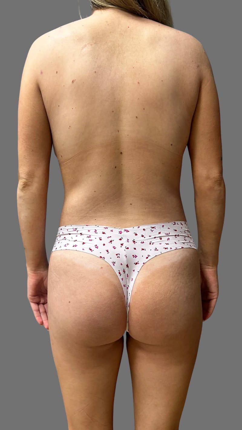 Brazilian Butt Lift Before & After Gallery - Patient 208773 - Image 2