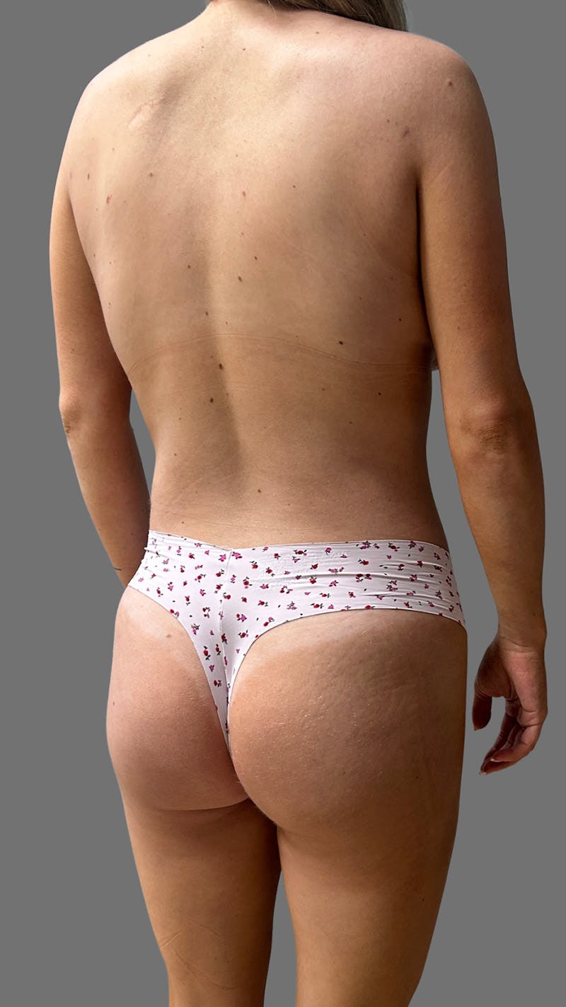 Brazilian Butt Lift Before & After Gallery - Patient 208773 - Image 4