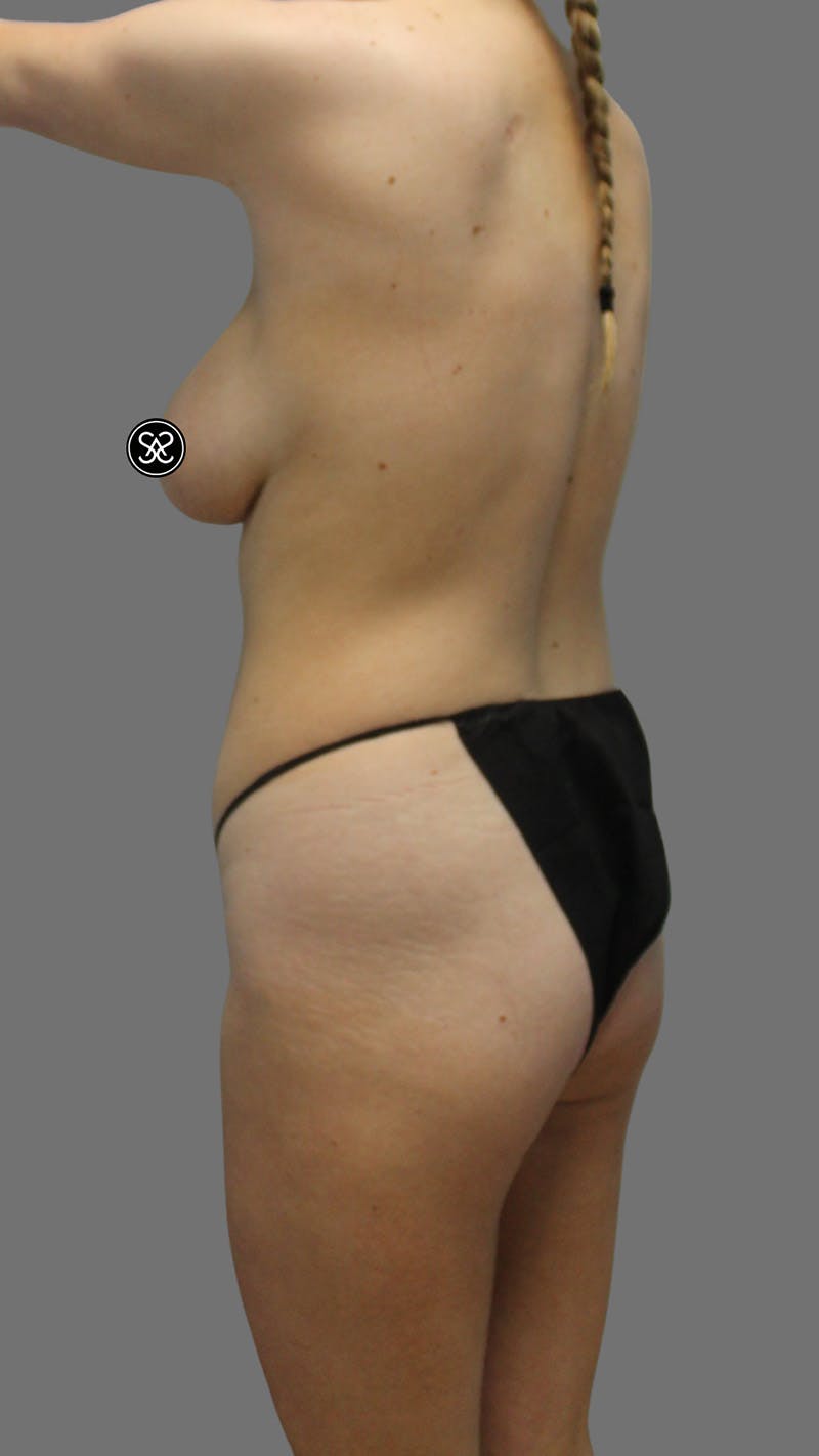 Brazilian Butt Lift Before & After Gallery - Patient 208773 - Image 5