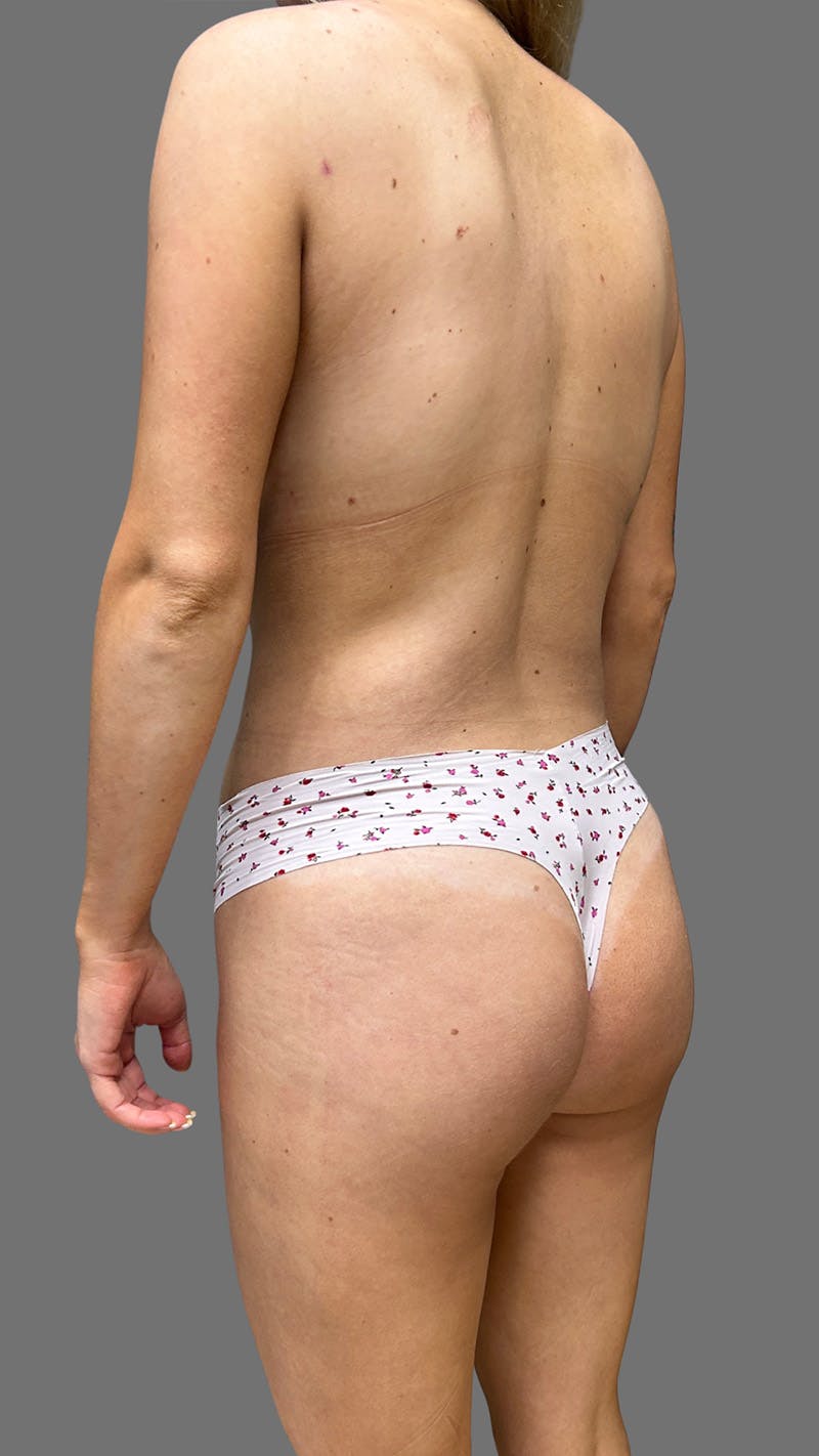 Brazilian Butt Lift Before & After Gallery - Patient 208773 - Image 6