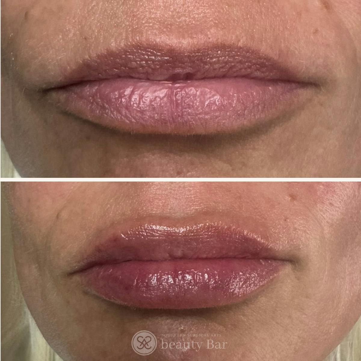 Facial Fillers Before & After Gallery - Patient 425455 - Image 1