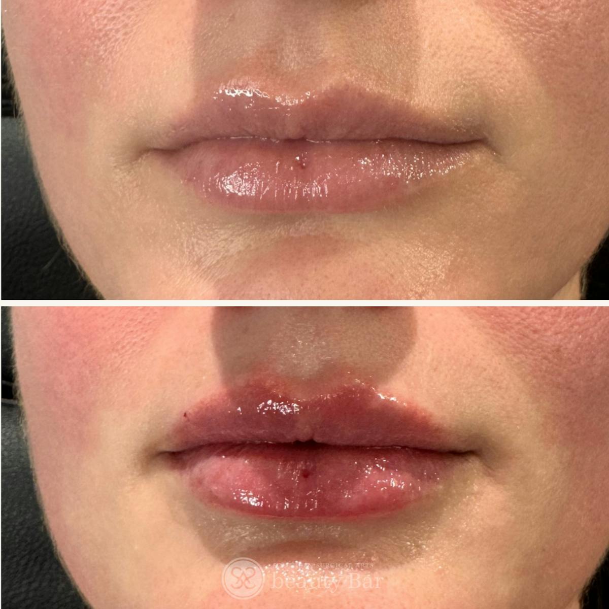 Facial Fillers Before & After Gallery - Patient 368147 - Image 1