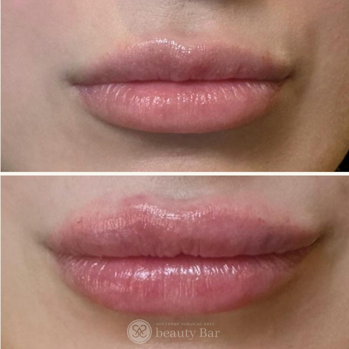 Facial Fillers Before & After Gallery - Patient 162777 - Image 1