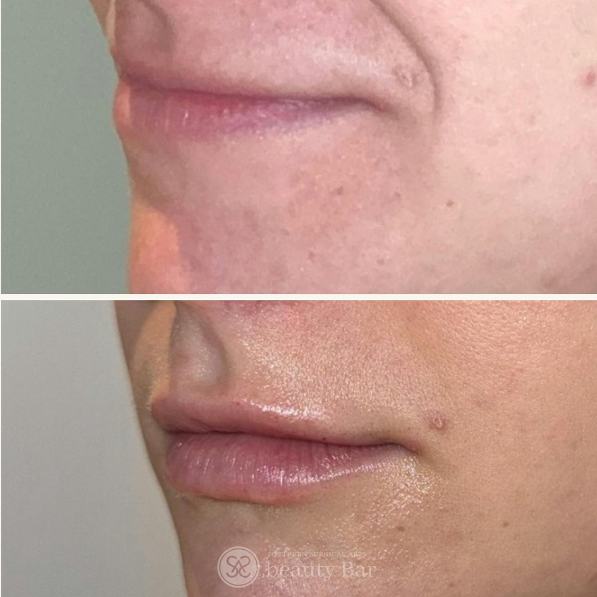 Facial Fillers Before & After Gallery - Patient 193608 - Image 1