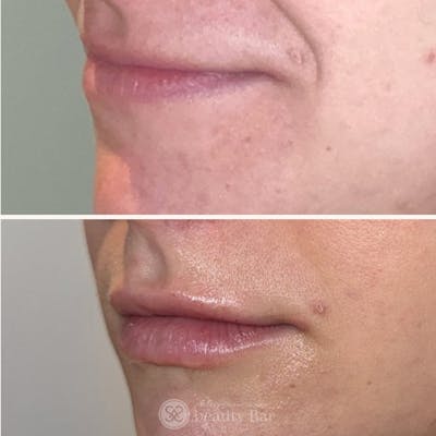 Facial Fillers Before & After Gallery - Patient 193608 - Image 1