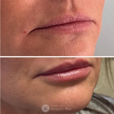 Facial Fillers Before & After Gallery - Patient 113520 - Image 1