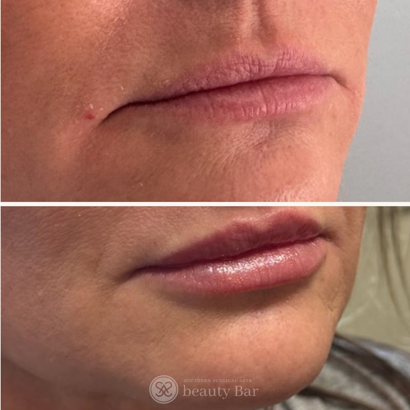 Facial Fillers Before & After Gallery - Patient 113520 - Image 1