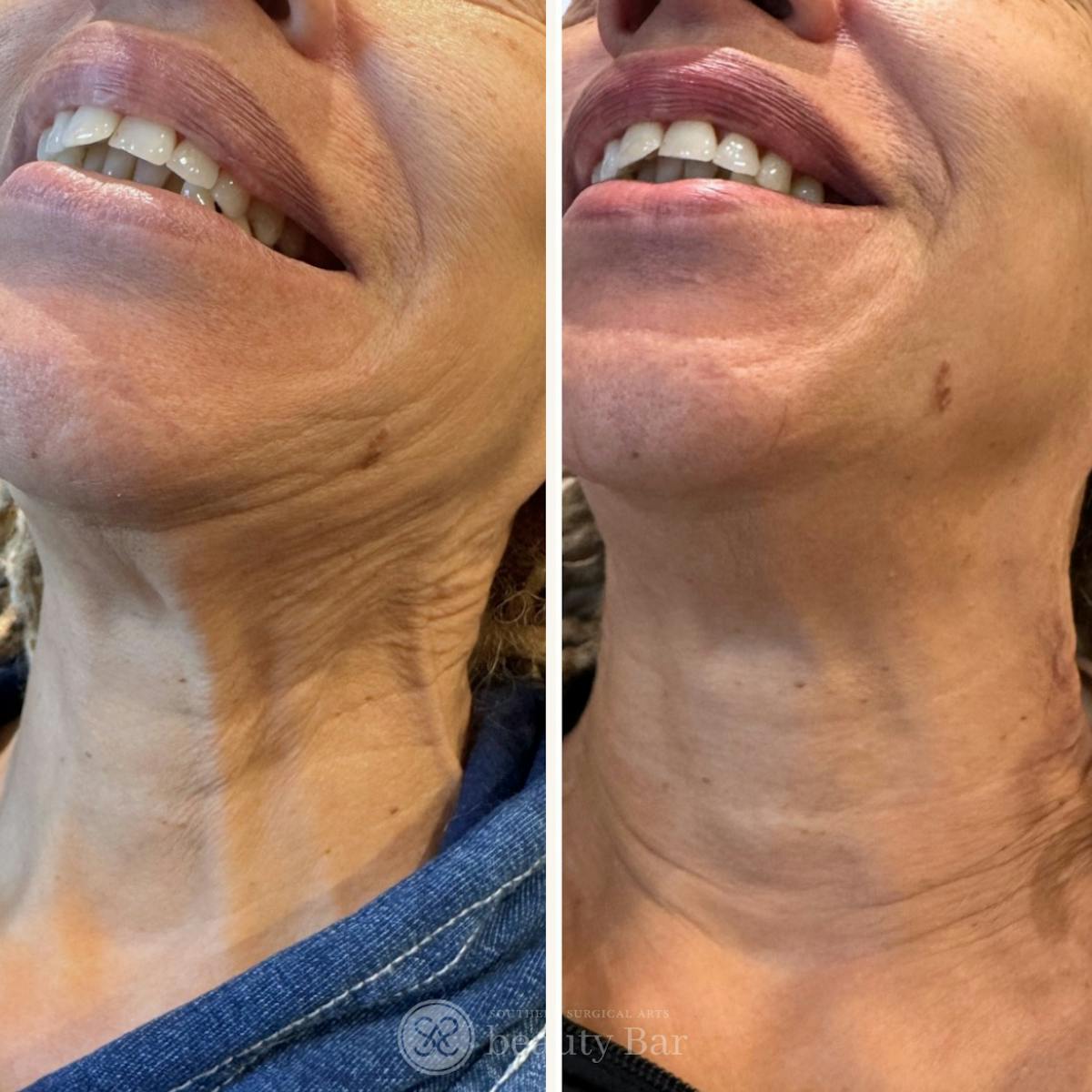 Neuromodulator Injections Before & After Gallery - Patient 419076 - Image 1