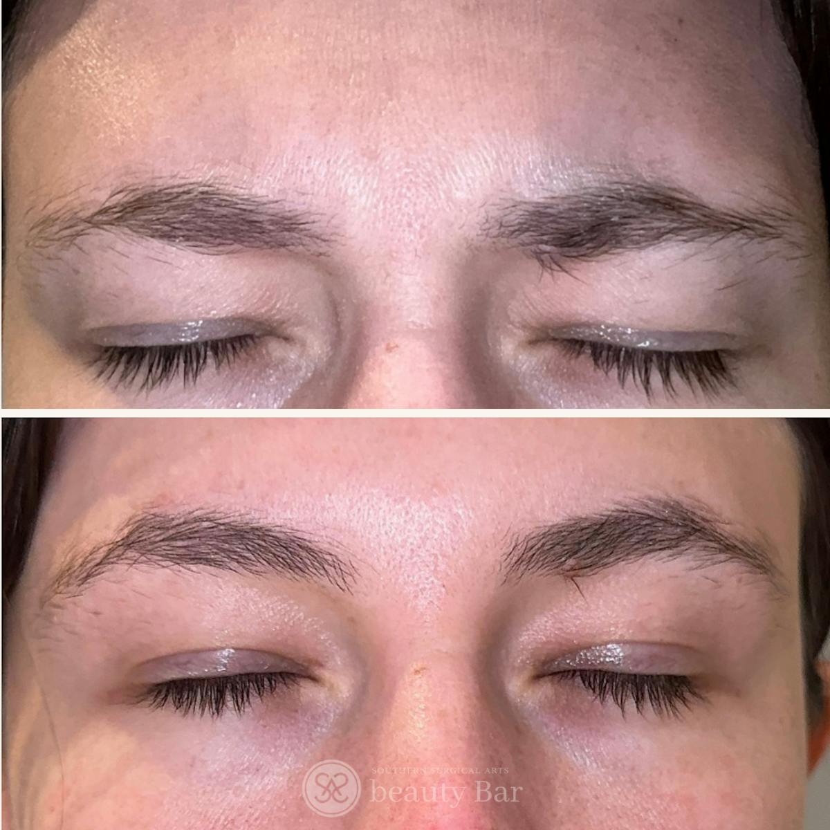Neuromodulator Injections Before & After Gallery - Patient 372596 - Image 1