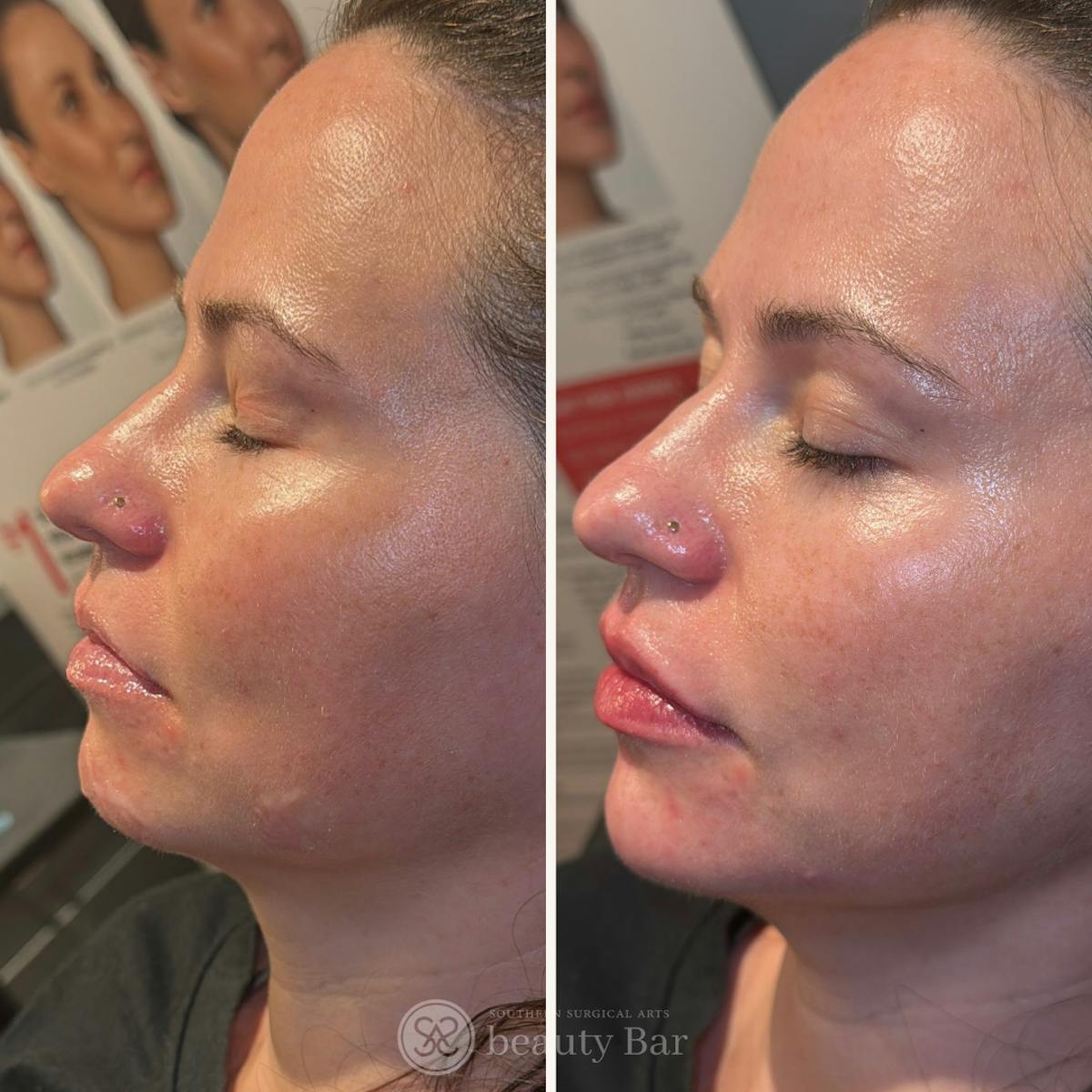 Facial Fillers Before & After Gallery - Patient 429087 - Image 1