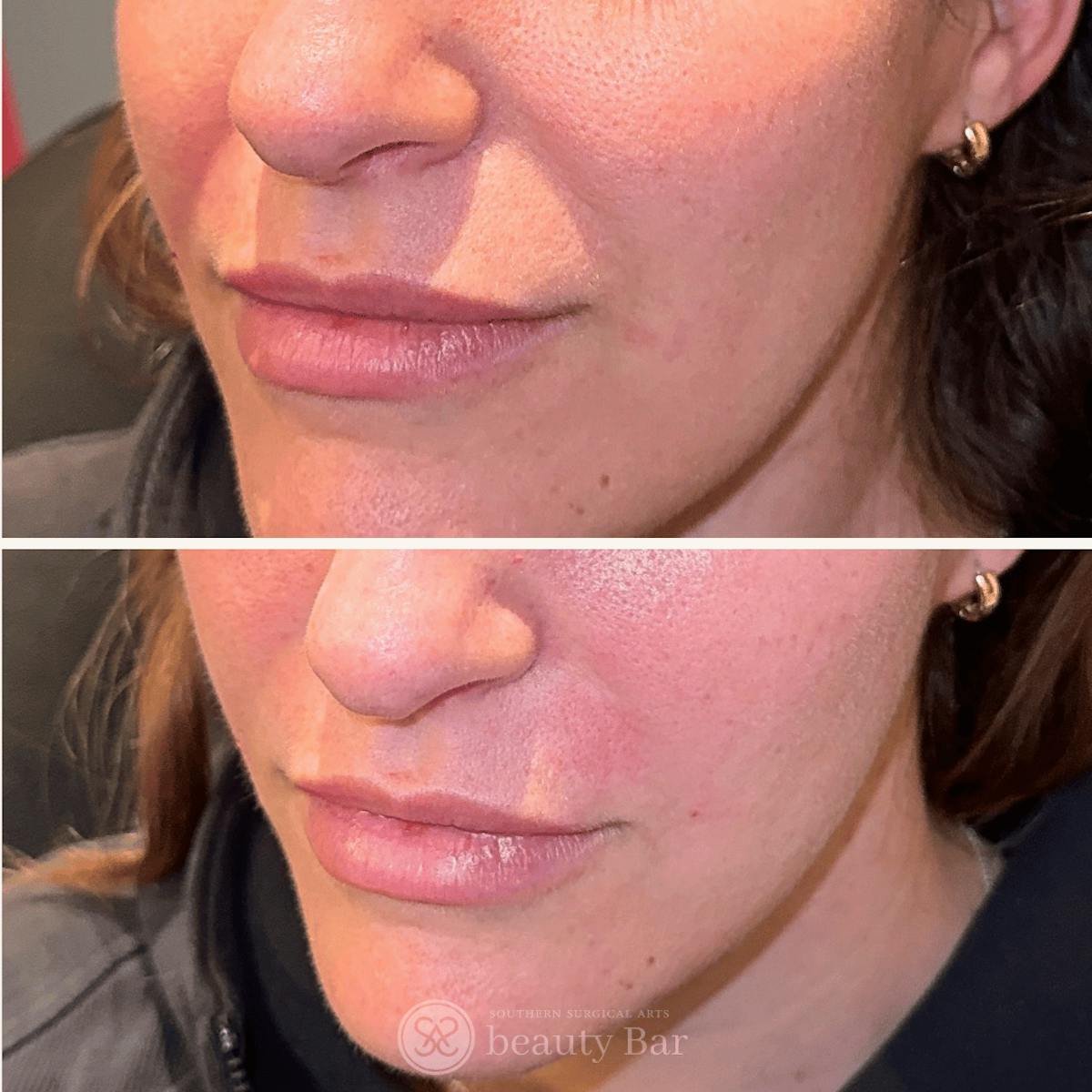 Facial Fillers Before & After Gallery - Patient 402282 - Image 1