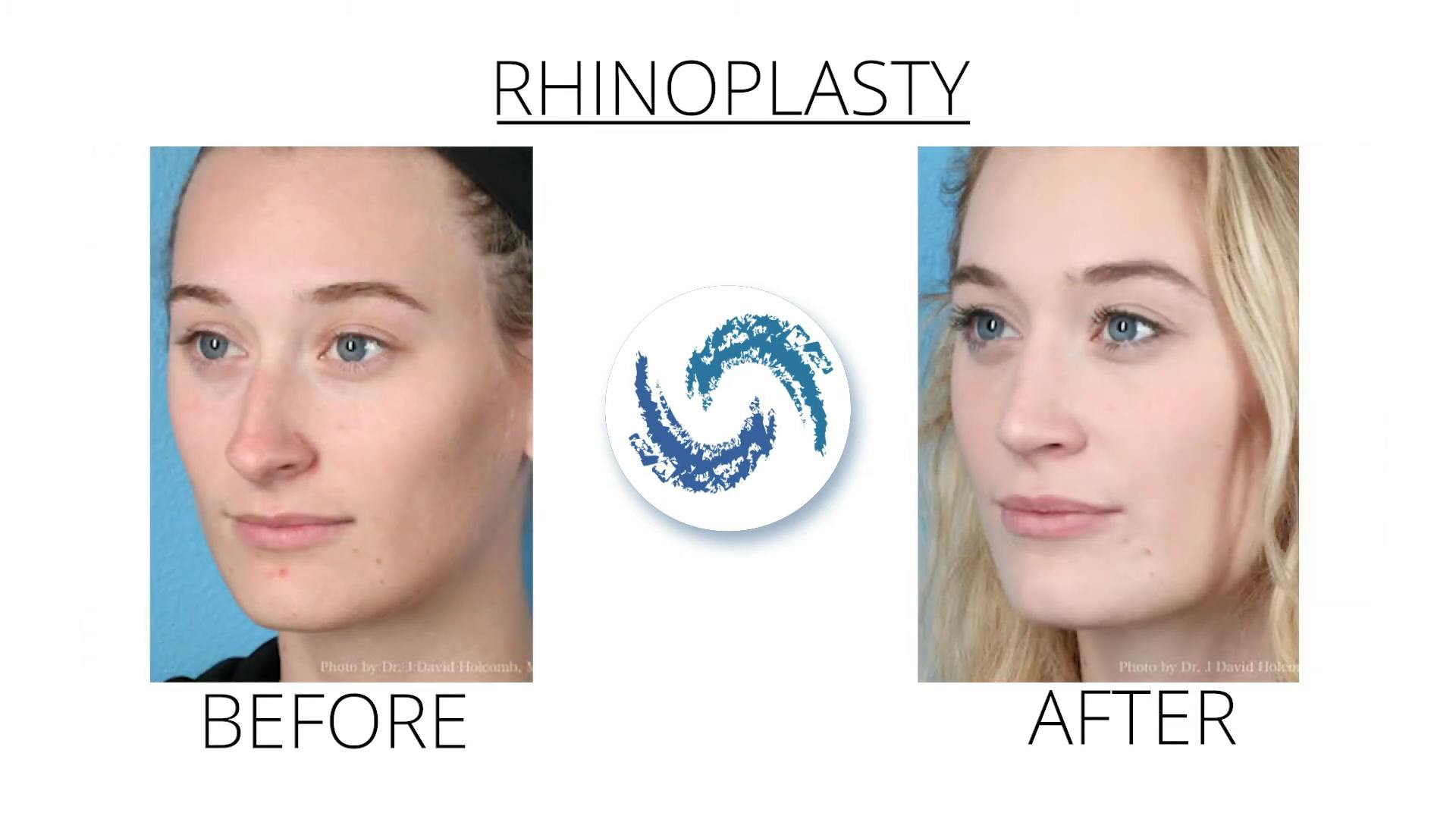 before and after rhinoplasty video testimonial