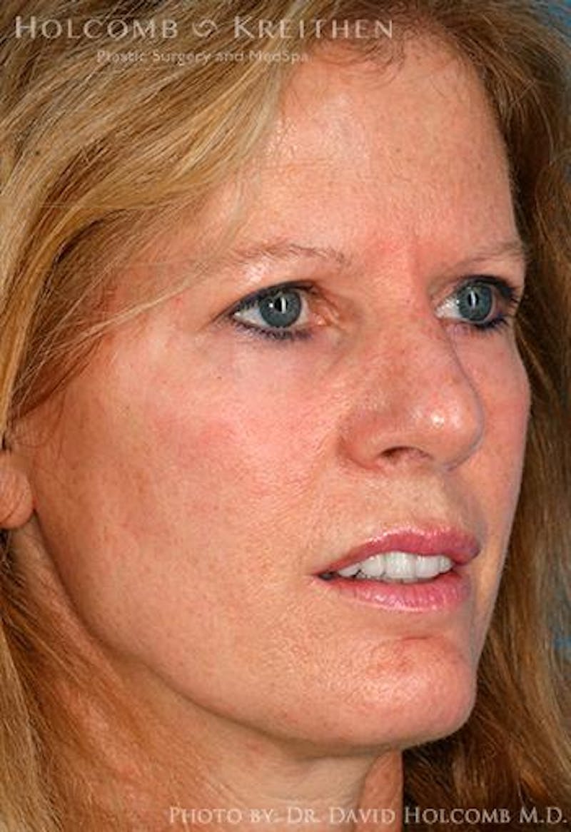 TRL Laser Skin Resurfacing Before & After Gallery - Patient 222129 - Image 2