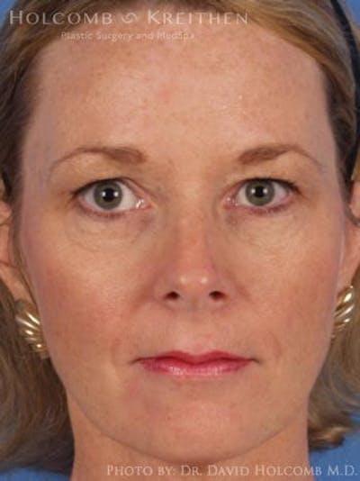 Energy Assisted Face/Neck Lift Before & After Gallery - Patient 282061 - Image 1