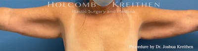 Arm Lift Before & After Gallery - Patient 372748 - Image 1
