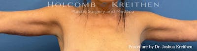 Arm Lift Before & After Gallery - Patient 372748 - Image 2