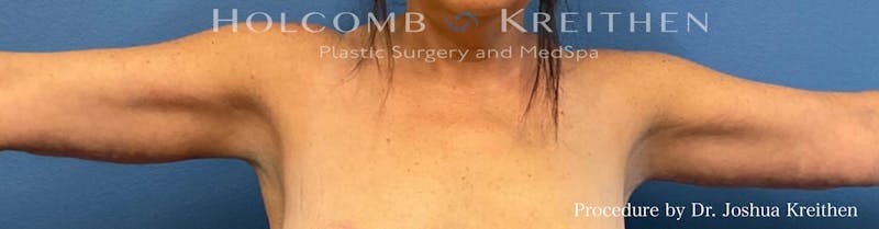 Arm Lift Before & After Gallery - Patient 372748 - Image 2