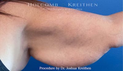 Arm Lift Before & After Gallery - Patient 239731 - Image 1