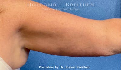 Arm Lift Before & After Gallery - Patient 239731 - Image 2