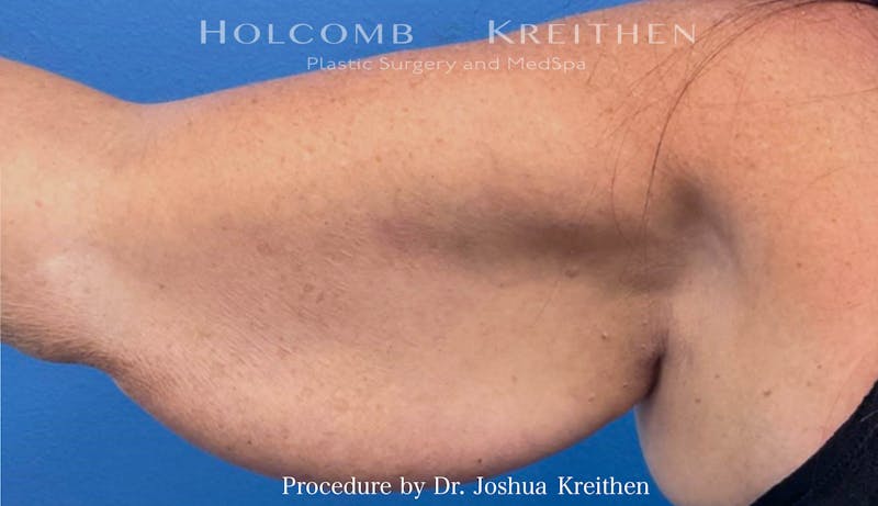 Arm Lift Before & After Gallery - Patient 239731 - Image 3