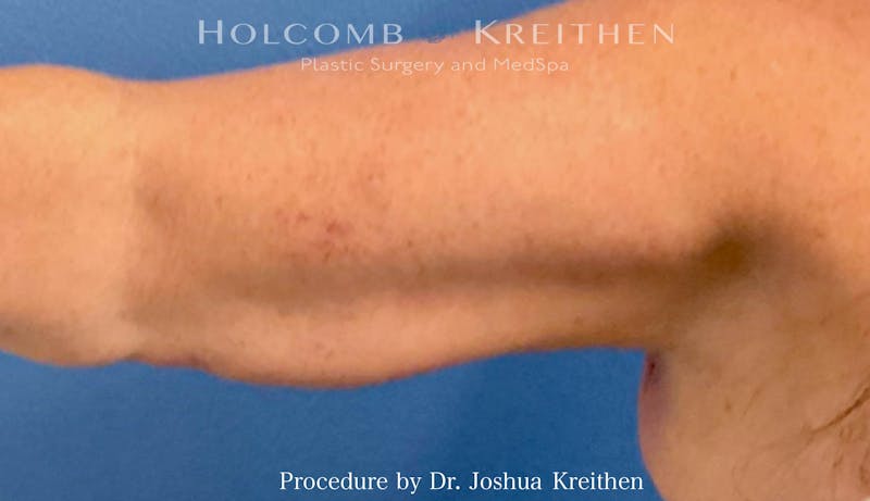 Arm Lift Before & After Gallery - Patient 239731 - Image 4