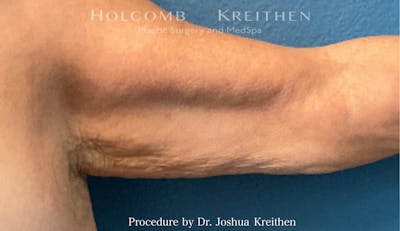 Arm Lift Before & After Gallery - Patient 441337 - Image 1