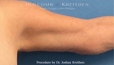 Arm Lift Before & After Gallery - Patient 441337 - Image 2