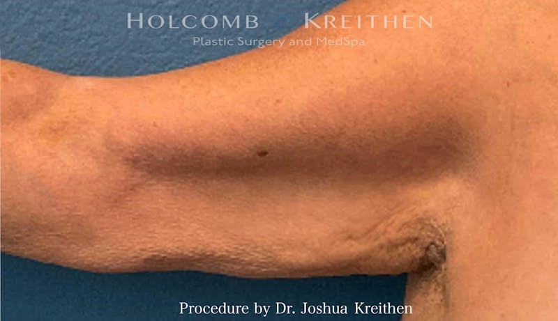 Arm Lift Before & After Gallery - Patient 441337 - Image 3