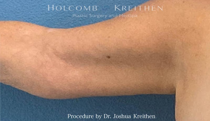 Arm Lift Before & After Gallery - Patient 441337 - Image 4