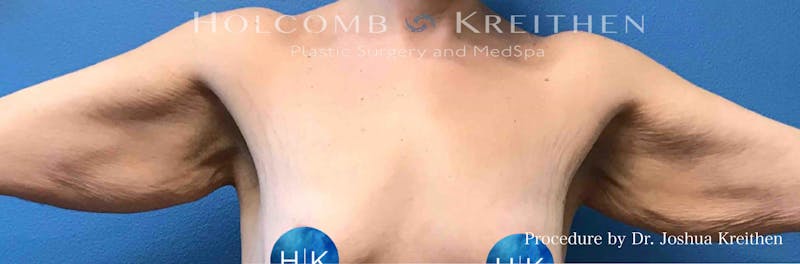 Arm Lift Before & After Gallery - Patient 380673 - Image 1