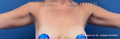 Arm Lift Before & After Gallery - Patient 380673 - Image 2