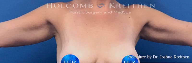 Arm Lift Before & After Gallery - Patient 380673 - Image 2