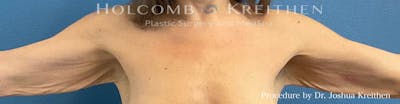 Arm Lift Before & After Gallery - Patient 266262 - Image 1