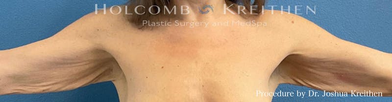 Arm Lift Before & After Gallery - Patient 266262 - Image 1