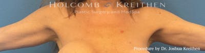 Arm Lift Before & After Gallery - Patient 266262 - Image 2