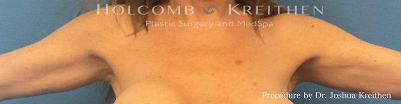 Arm Lift Before & After Gallery - Patient 266262 - Image 2
