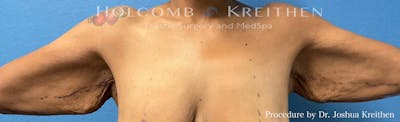 Arm Lift Before & After Gallery - Patient 601216 - Image 1