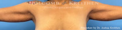 Arm Lift Before & After Gallery - Patient 601216 - Image 2