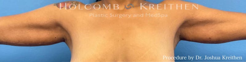 Arm Lift Before & After Gallery - Patient 601216 - Image 2