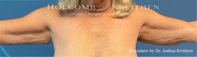 Arm Lift Before & After Gallery - Patient 231159 - Image 1