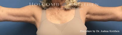 Arm Lift Before & After Gallery - Patient 231159 - Image 2
