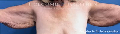 Arm Lift Before & After Gallery - Patient 104733 - Image 1