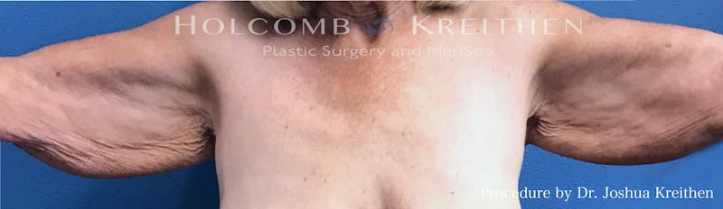 Arm Lift Before & After Gallery - Patient 104733 - Image 1